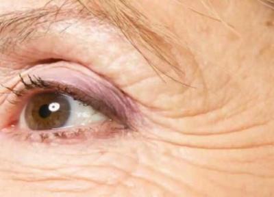 همه چیز درباره چین و چروک های پنجه کلاغی